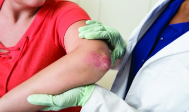 Artritis psoriásica