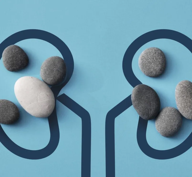 Imagen ilustrativa sobre cálculos renales vs. insuficiencia renal