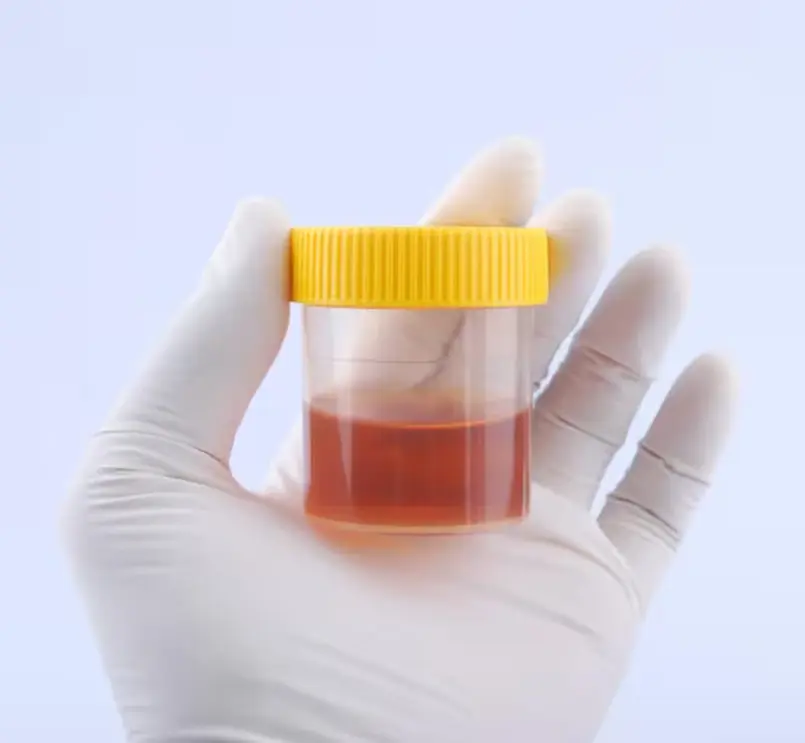 Imagen ilustrativa hematuria sangre en la orina