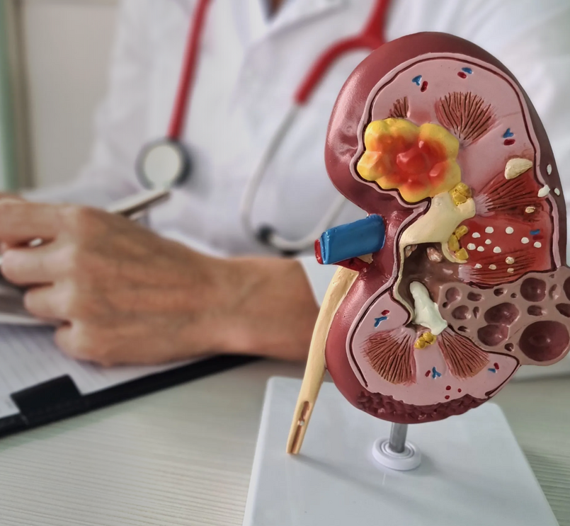Imagen ilustrativa insuficiencia renal