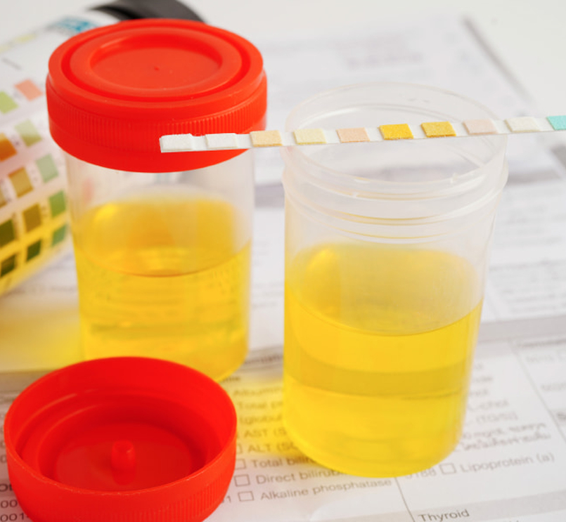 Albuminuria: qué es la albúmina en la orina | Novartis Argentina S.A.