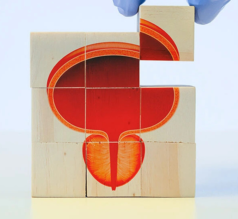 Hiperplasia Prostática Benigna: síntomas y diferencias con el cáncer de próstata