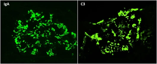 Inmunofluorescencia directa IgA 3+ y C3 3+ en patrón granular mesangial en Nefropatía IgA