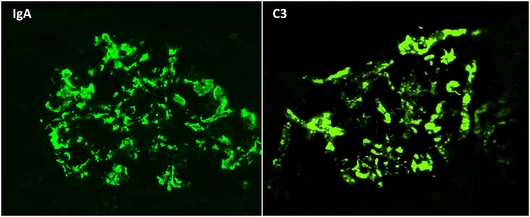 Inmunofluorescencia directa IgA 3+ y C3 3+ en patrón granular mesangial en Nefropatía IgA
