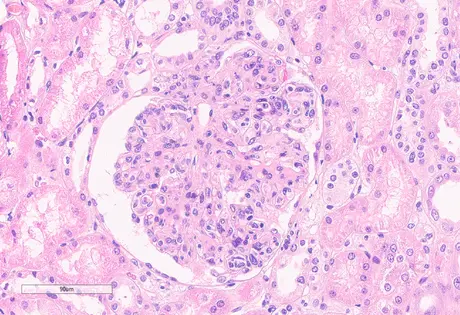 H&E que muestra patrón de GNMP, con hipercelularidad endocapilar y mesangial y engrosamiento de las paredes capilares. 40x.