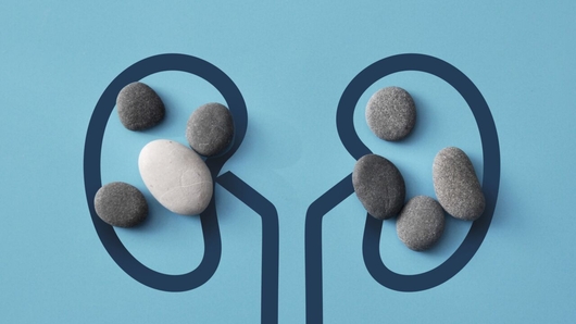 Imagen ilustrativa sobre cálculos renales vs. insuficiencia renal