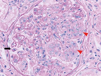 PAS con lesiones proliferativas en nefritis lúpica: glomérulo con hipercelularidad endocapilar mononuclear