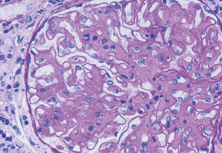 PAS con expansión mesangial y engrosamiento de paredes capilares por depósito acelular levemente PAS positivo en glomerulonefritis fibrilar
