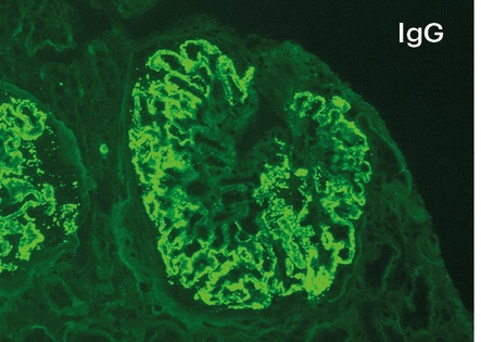IFD para IgG con depósitos pseudolineales 3+ en membrana basal glomerular en nefropatía membranosa