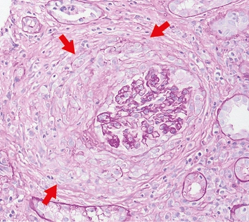 PAS con semiluna celular y proliferación extracapilar en la totalidad de la circunferencia del glomérulo en glomerulonefritis extracapilar