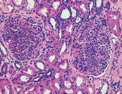 H&E con hipercelularidad mesangial y endocapilar en glomerulonefritis aguda postinfecciosa