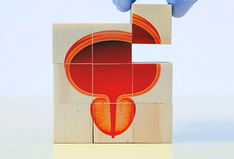 Hiperplasia Prostática Benigna: síntomas y diferencias con el cáncer de próstata