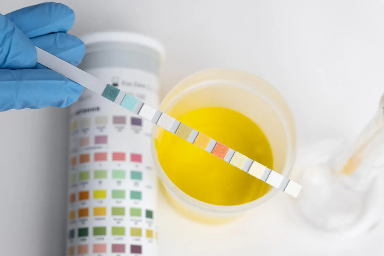 Imagen ilustrativa análisis de orina en laboratorio