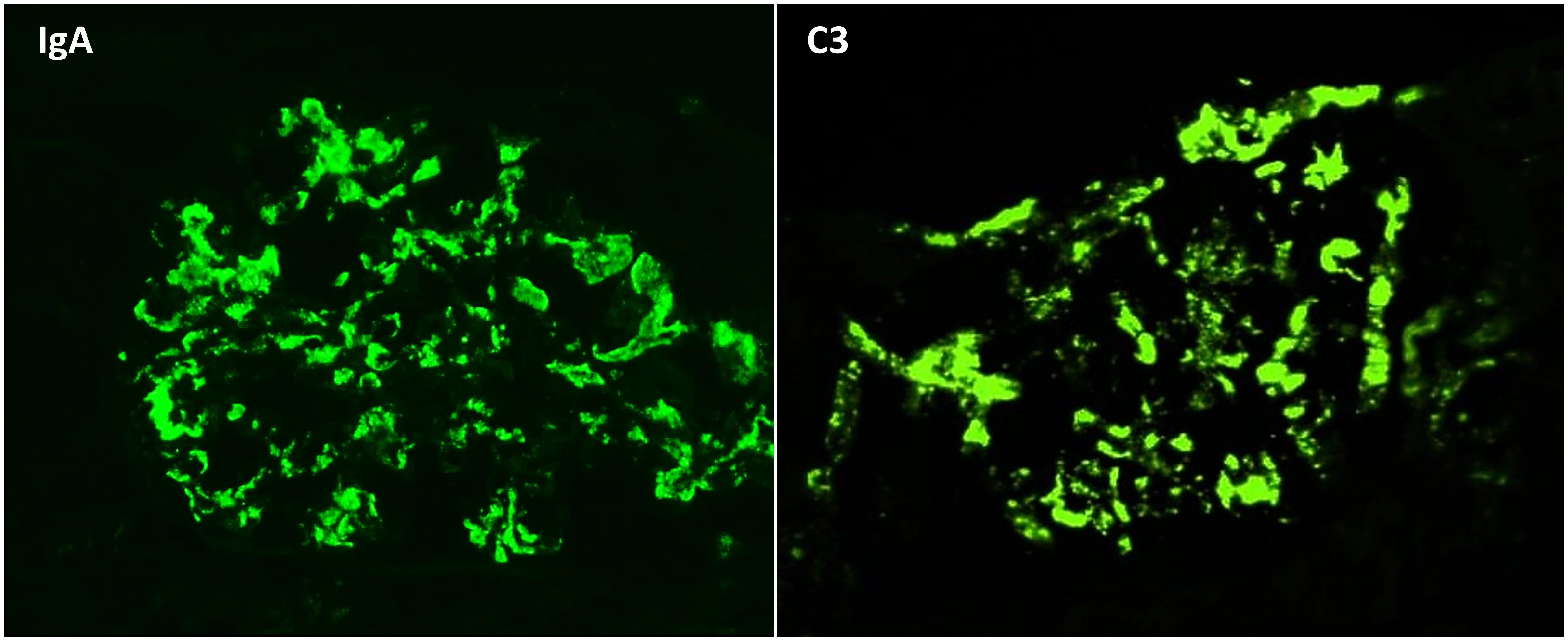 Inmunofluorescencia directa IgA 3+ y C3 3+ en patrón granular mesangial en Nefropatía IgA