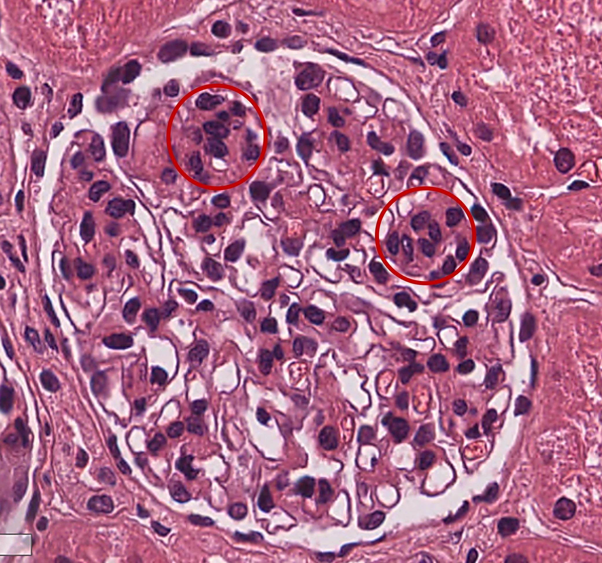 H&E con proliferación mesangial mayor de 3 células por área mesangial en Nefropatía IgA