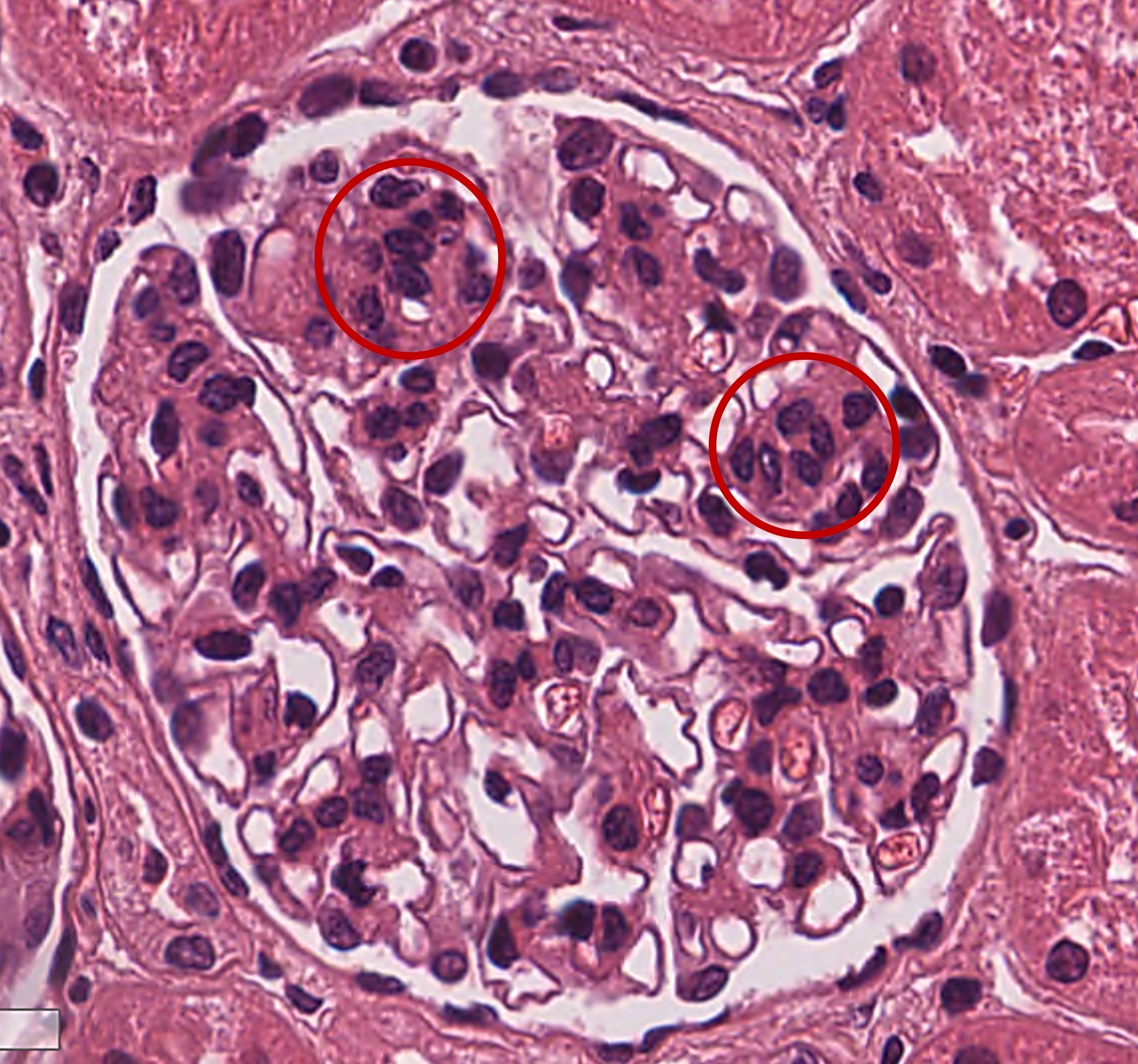 H&E con proliferación mesangial mayor de 3 células por área mesangial en Nefropatía IgA