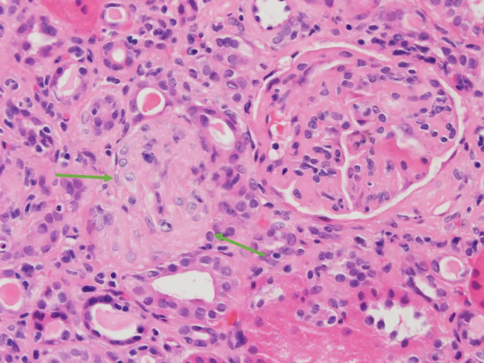 H&E. Glomérulo en un caso de MAT; muestra un aspecto hipercelular, y adyacente al mismo se observa una arteriola con hipertrofia intensa de la pared. 20x.