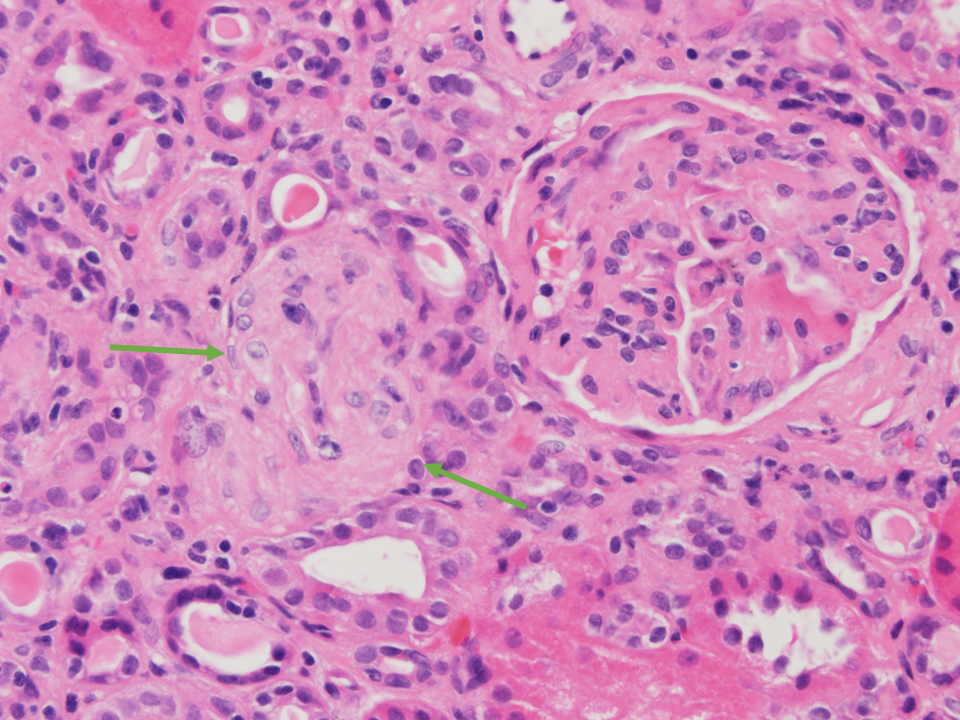 H&E. Glomérulo en un caso de MAT; muestra un aspecto hipercelular, y adyacente al mismo se observa una arteriola con hipertrofia intensa de la pared. 20x.