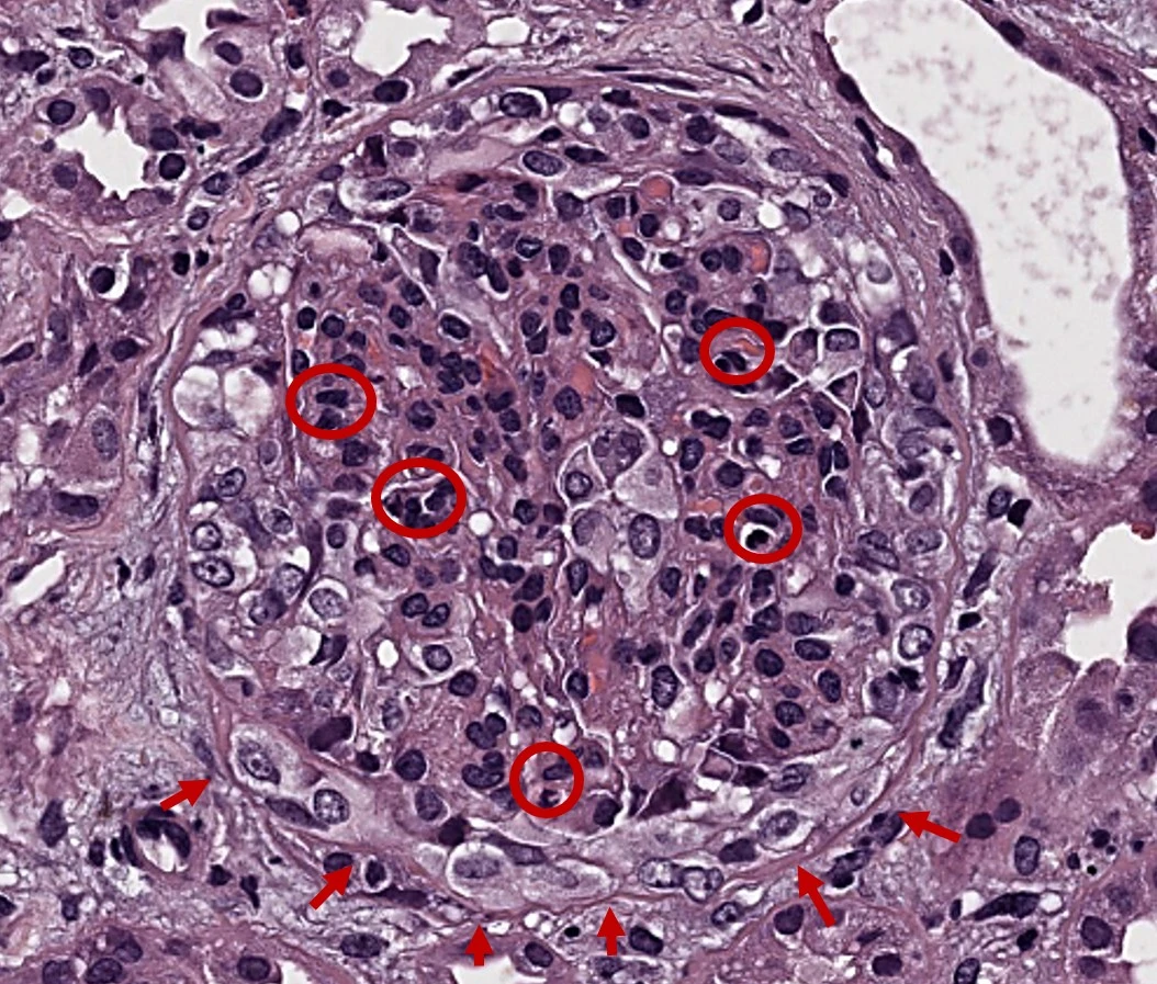 H&E de glomérulo con proliferación endocapilar y semiluna celular extracapilar en Nefropatía IgA
