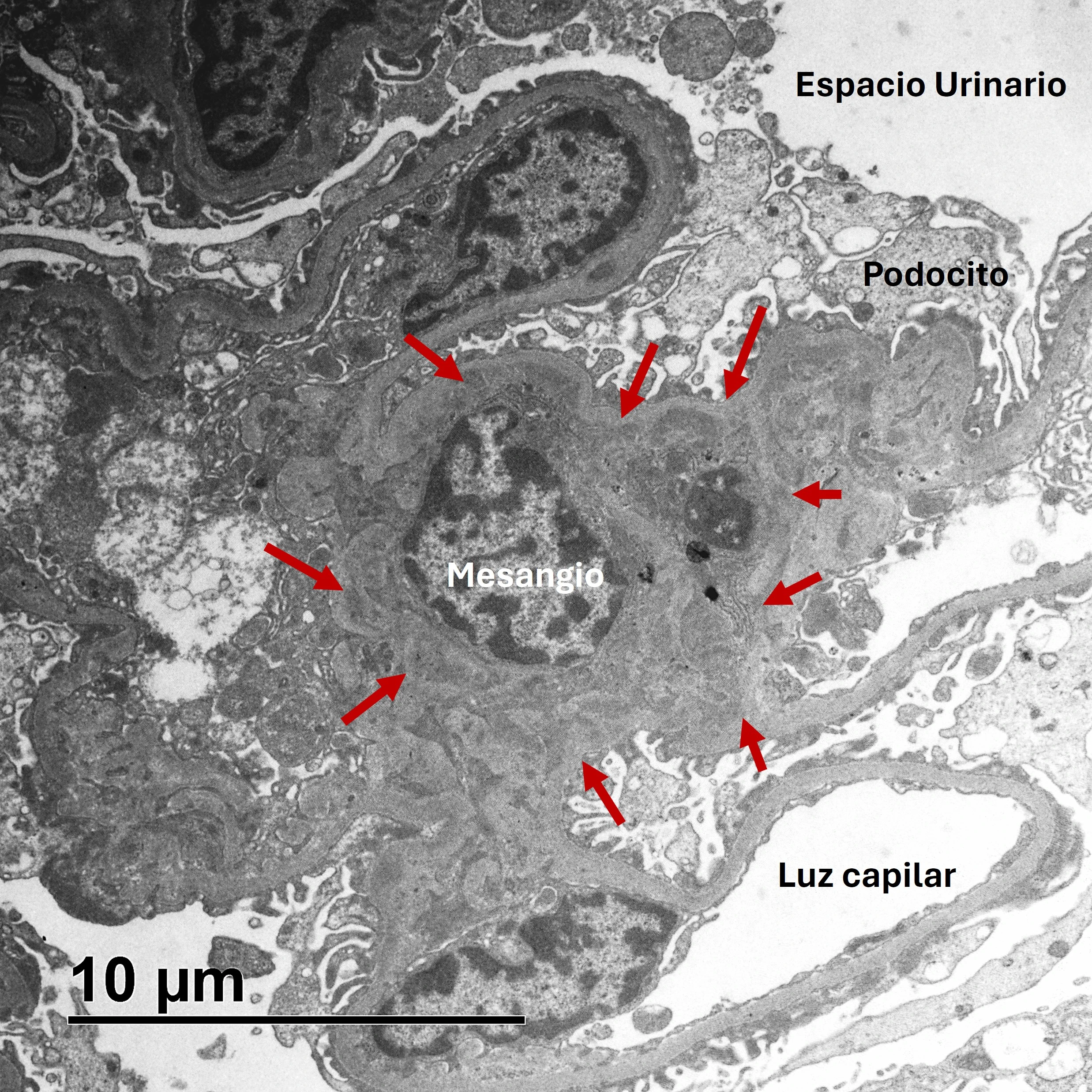 MET de glomérulo con abundantes depósitos mesangiales electrodensos en NefroIgA