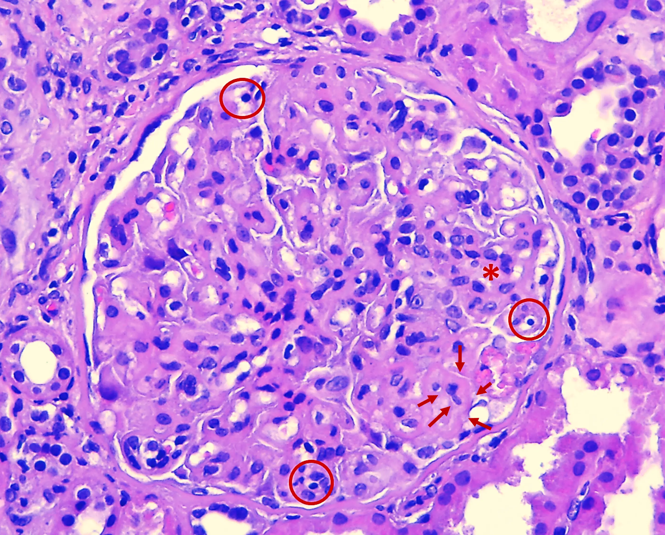Microscopía óptica H&E con patrón GNMP en Glomerulopatía C3: hipercelularidad endocapilar