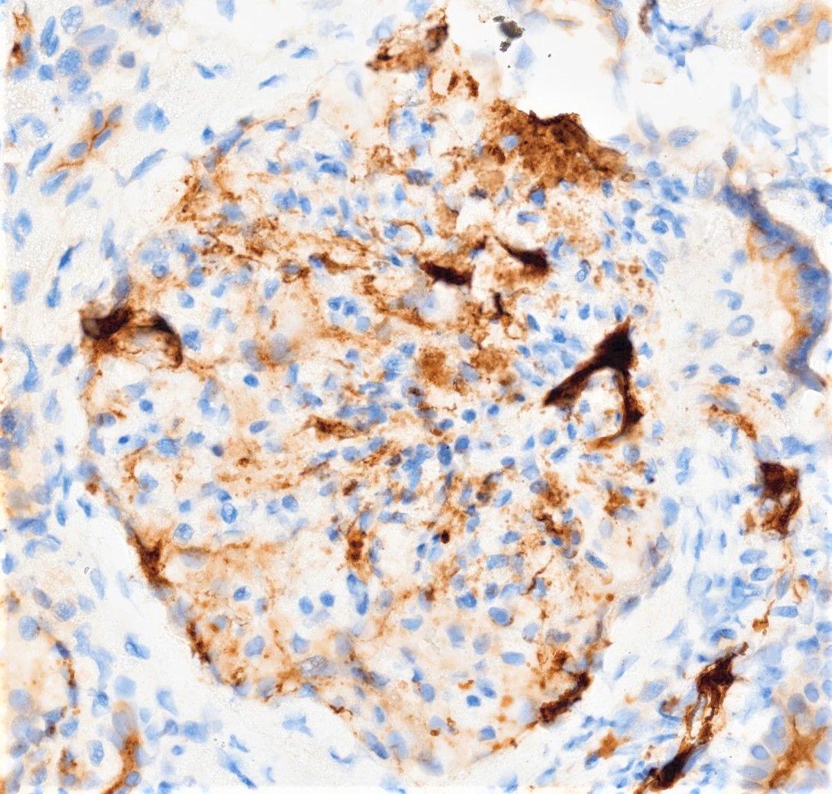 Tinción inmunohistoquímica para C4d con positividad mesangial granular en Nefropatía IgA