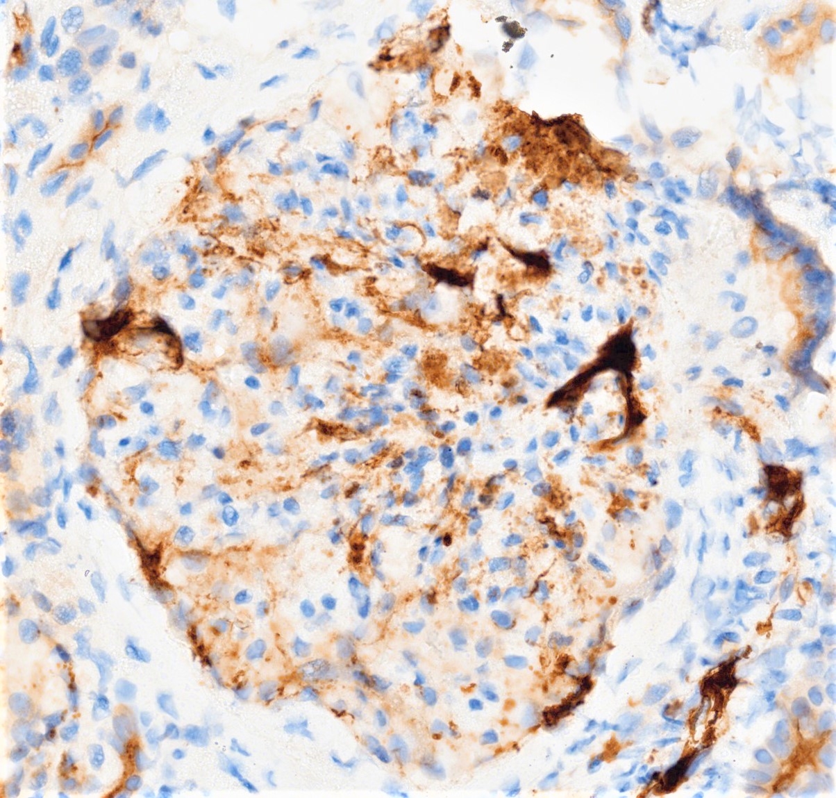 Tinción inmunohistoquímica para C4d con positividad mesangial granular en Nefropatía IgA