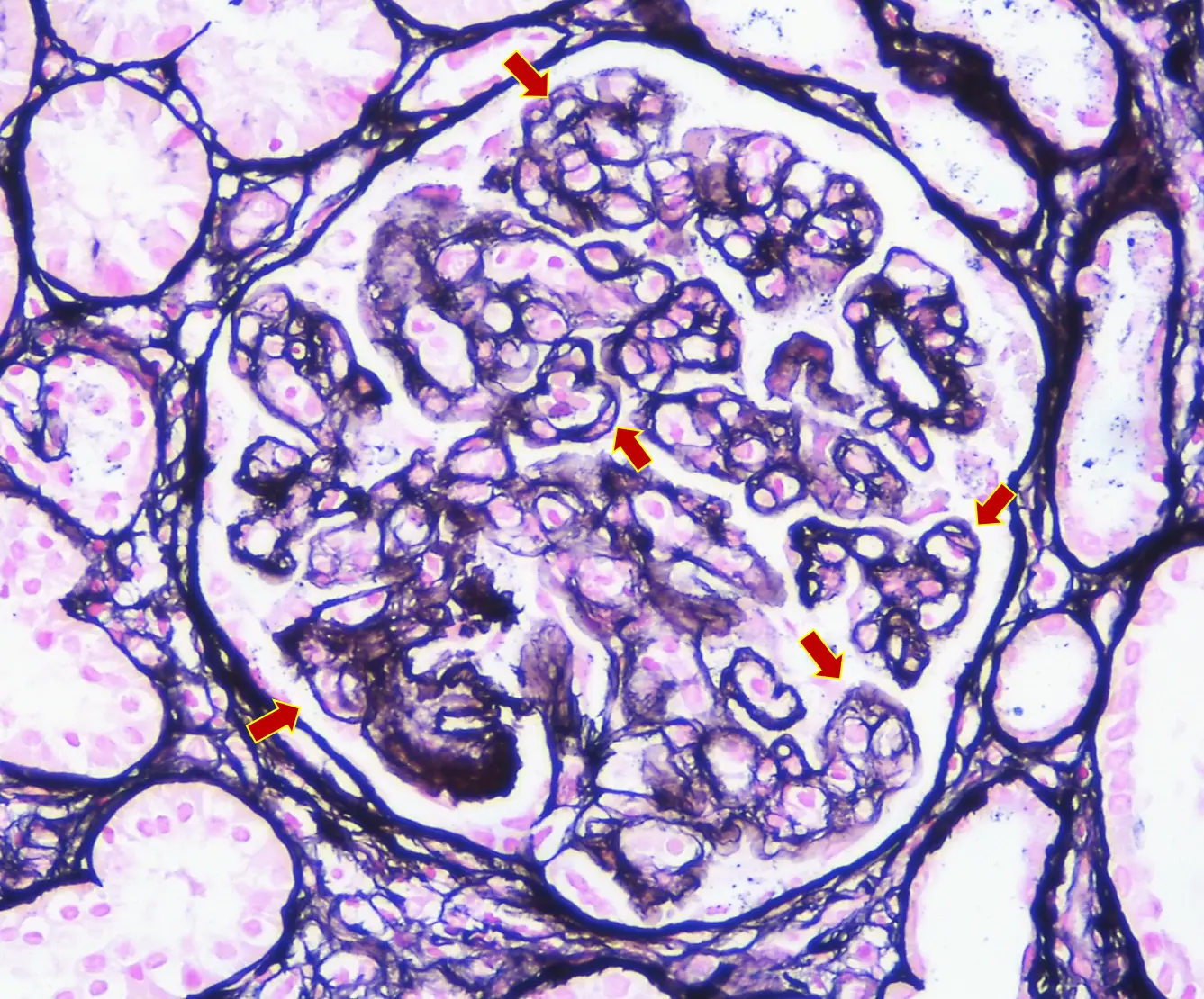 Tinción de plata metenamina con dobles contornos en membrana basal glomerular en GC3