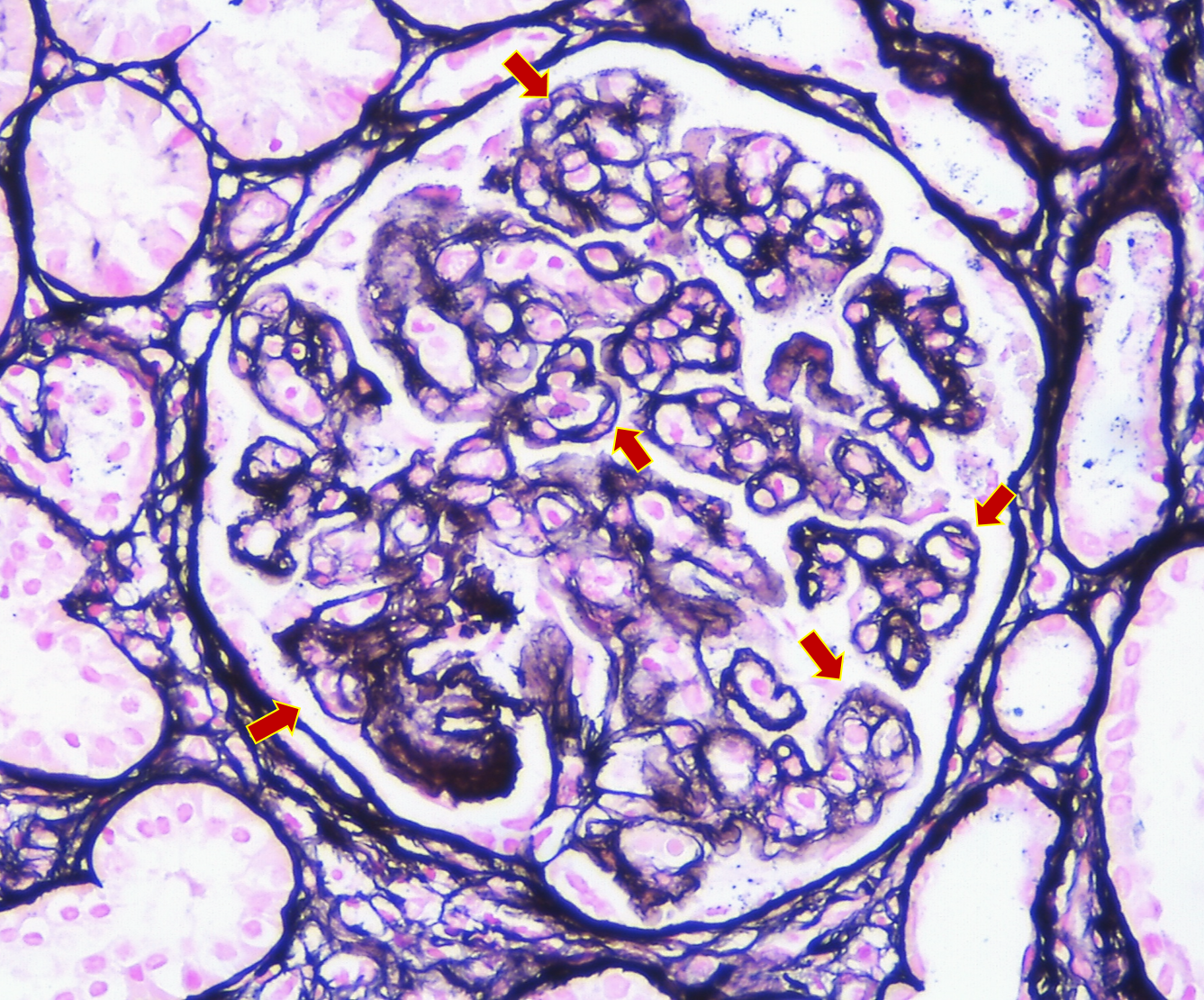 Tinción de plata metenamina con dobles contornos en membrana basal glomerular en GC3