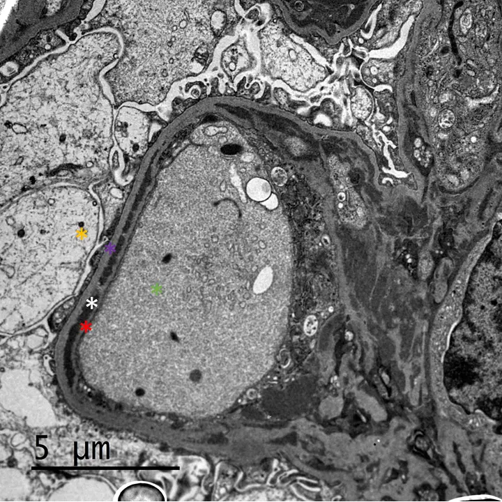 MET que muestra un asa capilar con depósitos subendoteliales electrodensos y duplicación de la membrana basal. Desde superior hacia el centro, espacio urinario con podocitos (*), membrana basal original (*), depósitos electrodensos subendoteliales (* blanco), luz capilar (*), membrana basal reduplicada (*). 50000x.