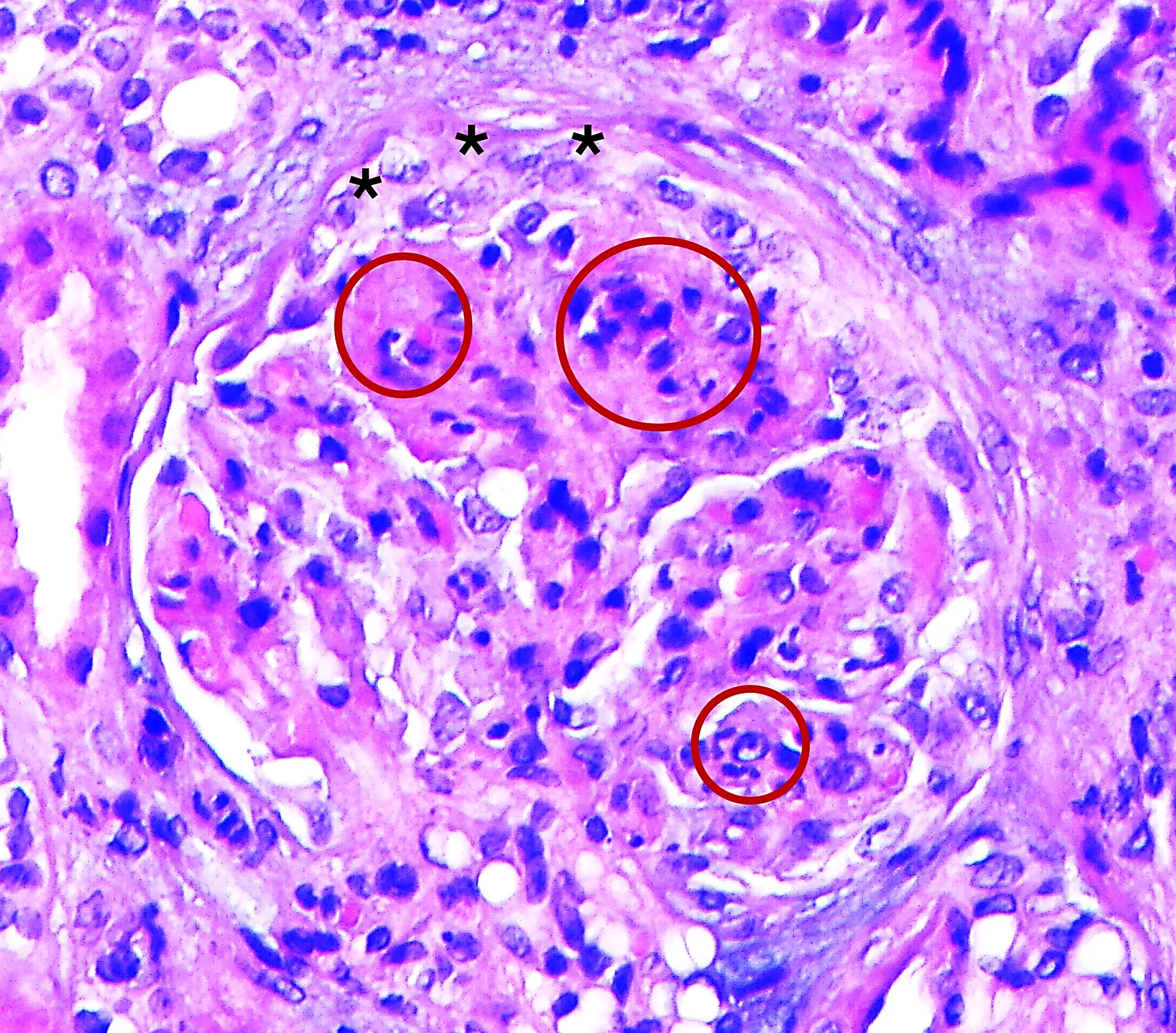 H&E con proliferación extracapilar fibrocelular en Glomerulopatía C3