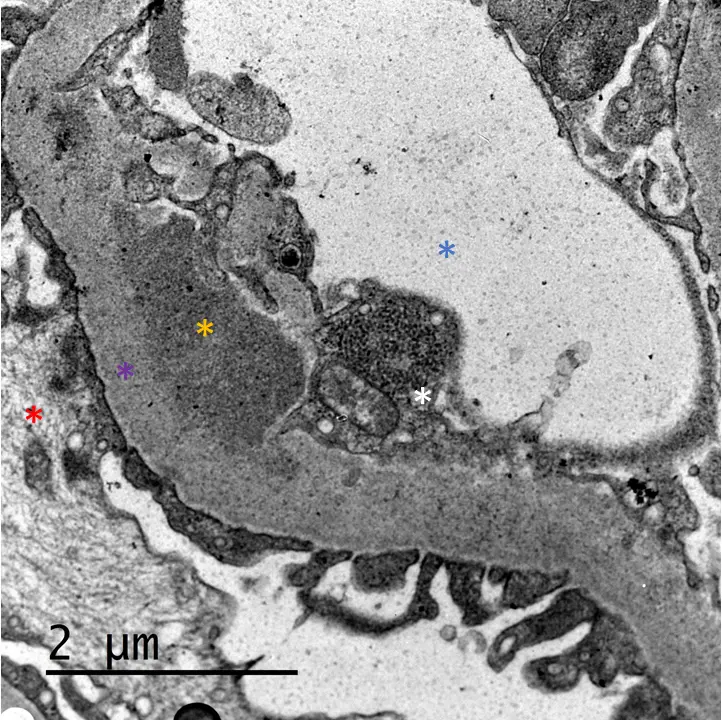 MET que muestra depósitos electrodensos no estructurados subendoteliales y presencia de una inclusión túbulo-reticular en una célula endotelial, en caso de una nefritis lúpica con patrón de GNMP. Desde la izquierda hacia el centro, podocito (*), membrana basal (*), depósito electrodenso subendotelial (* blanco), célula endotelial con inclusión túbulo-reticular (*) y luz capilar (*). 20000x.