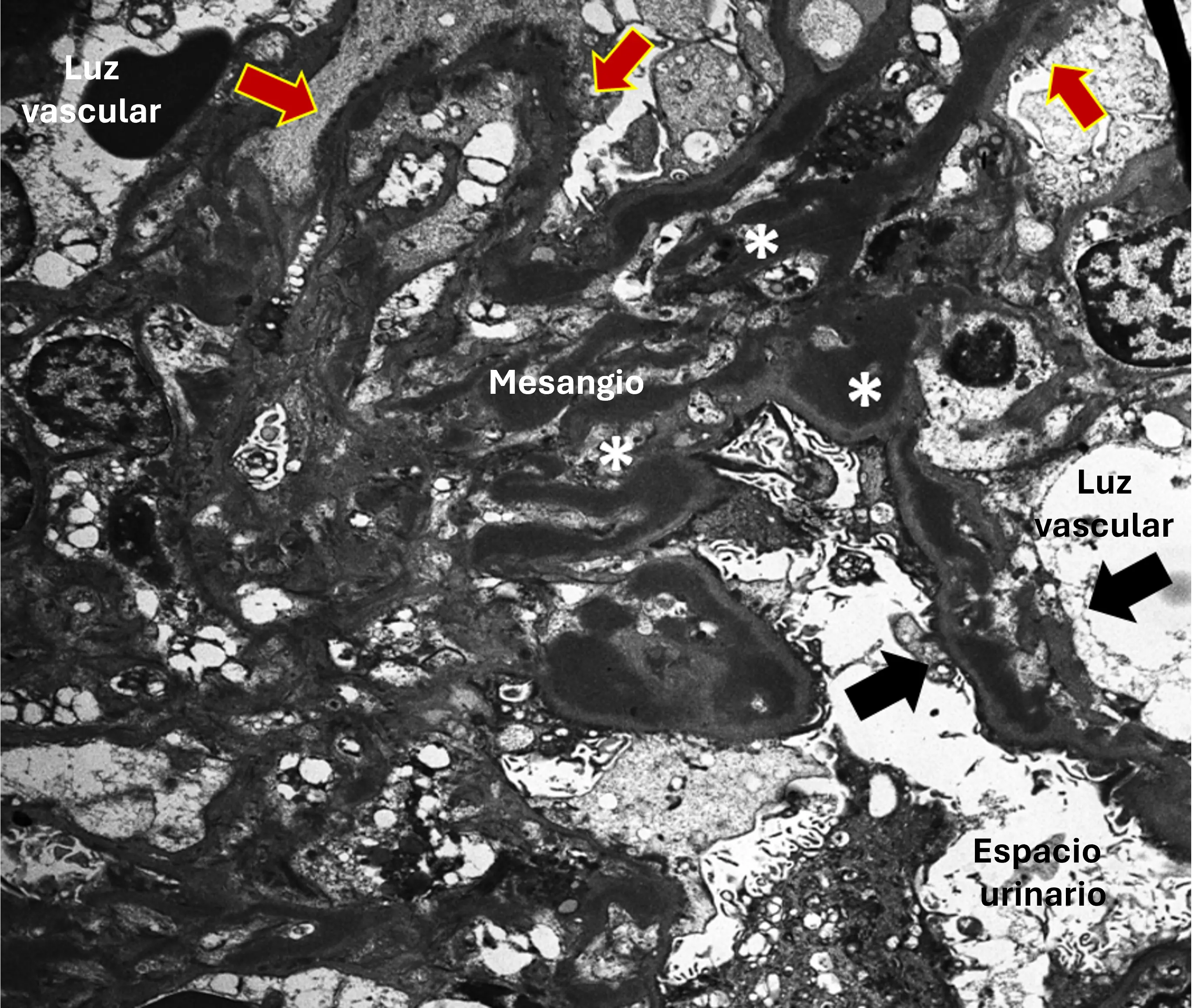 MET de enfermedad por depósitos densos (EDD): depósitos electrodensos en lámina densa