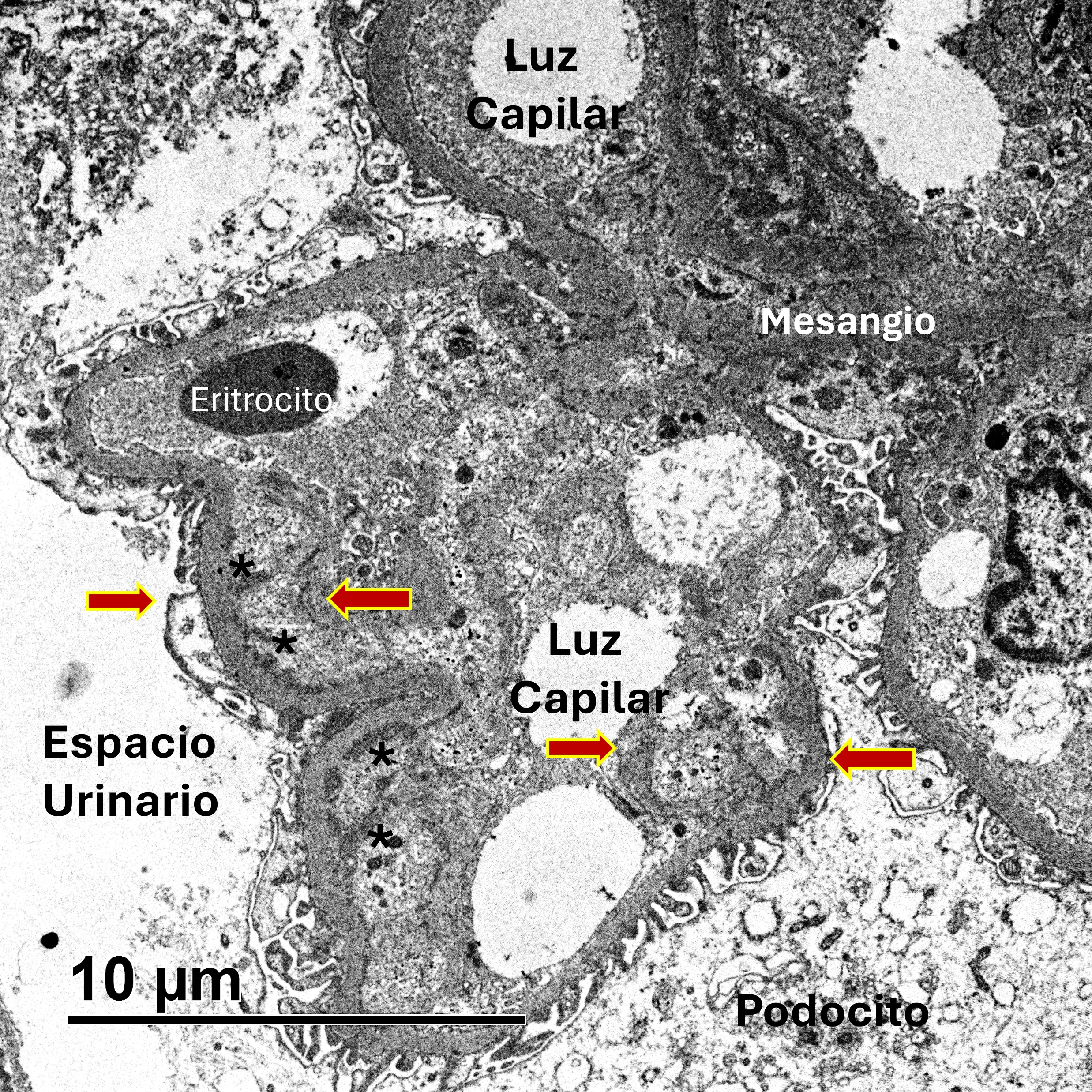 MET de GNC3 con dobles contornos y depósitos subendoteliales en asas capilares