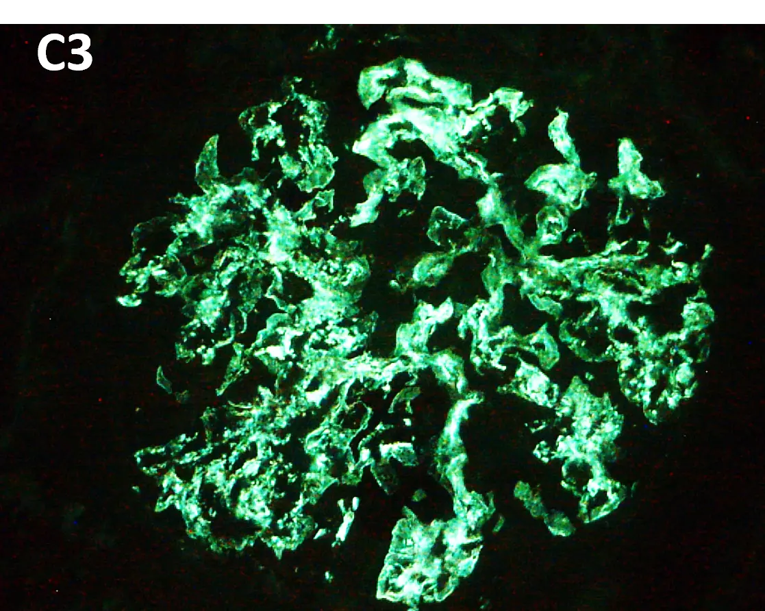 Inmunofluorescencia directa para C3c positiva 3+ en Glomerulopatía C3