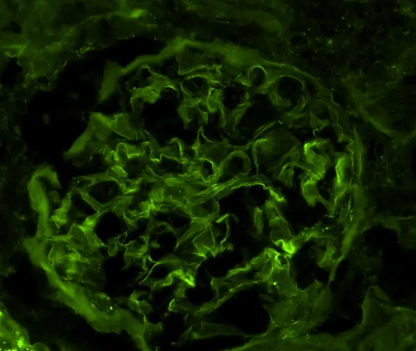Inmunofluorescencia negativa para IgG en Glomerulopatía C3
