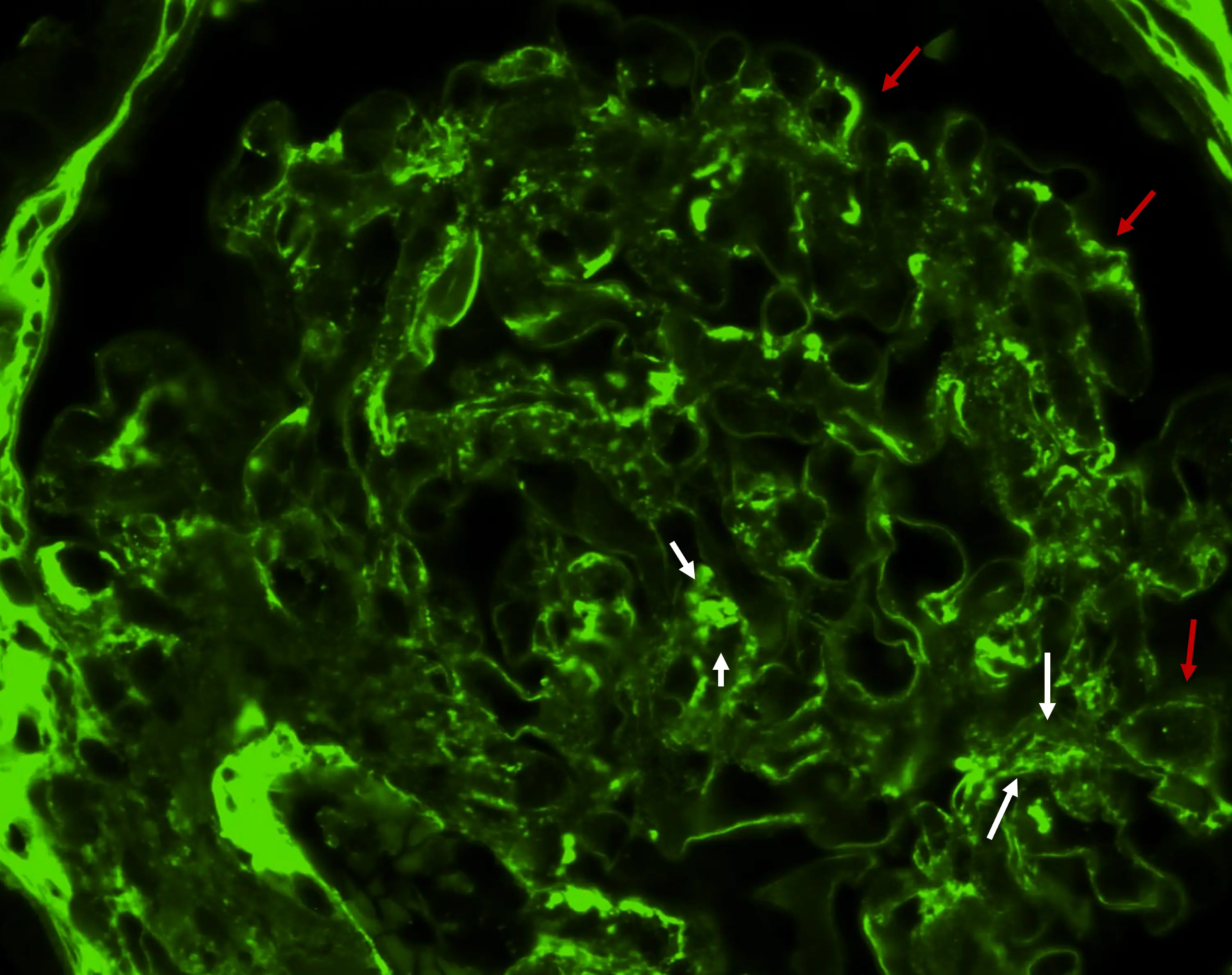 IFD con positividad débil trazas para IgG en GC3
