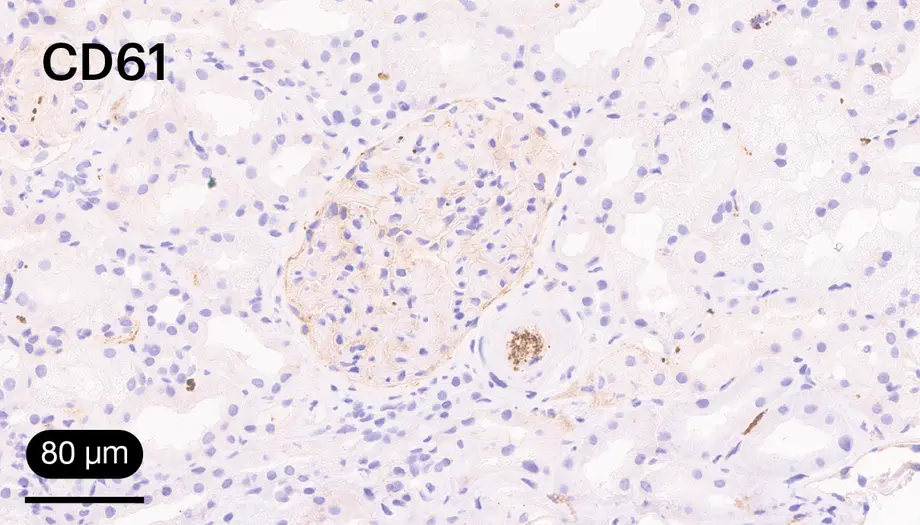 IHQ para CD61. Imagen de un trombo plaquetario junto a un glomérulo de aspecto hipercelular, correspondientes a un caso de MAT. 20x.