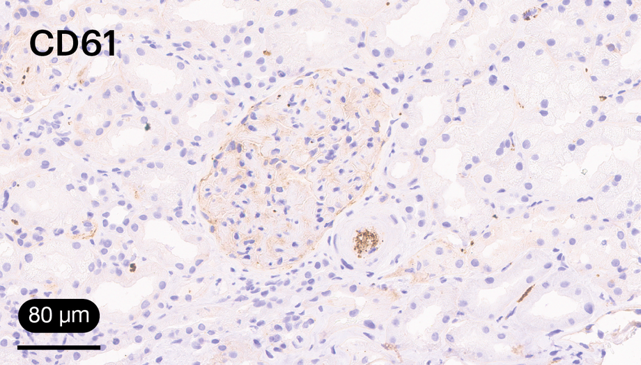 IHQ para CD61. Imagen de un trombo plaquetario junto a un glomérulo de aspecto hipercelular, correspondientes a un caso de MAT. 20x.