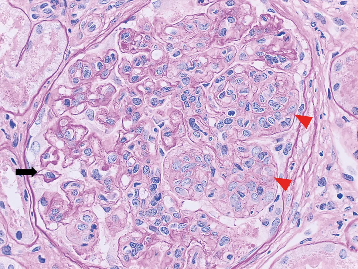 PAS con lesiones proliferativas en nefritis lúpica: glomérulo con hipercelularidad endocapilar mononuclear