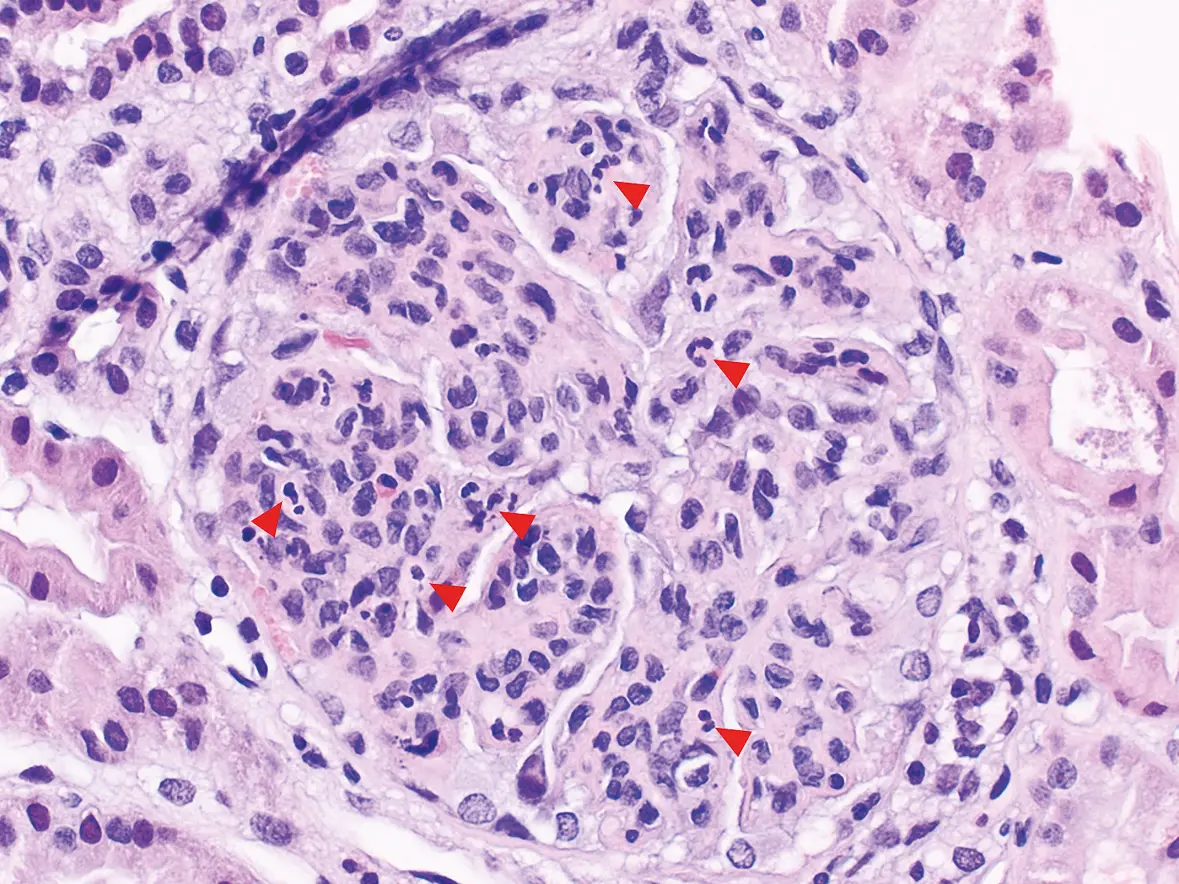 H&E con lesiones proliferativas en nefritis lúpica: hipercelularidad glomerular, cariorrexis y neutrófilos