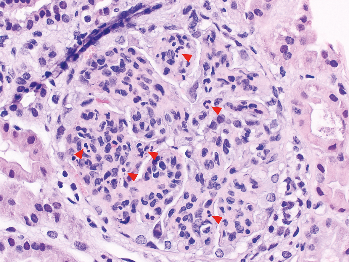 H&E con lesiones proliferativas en nefritis lúpica: hipercelularidad glomerular, cariorrexis y neutrófilos