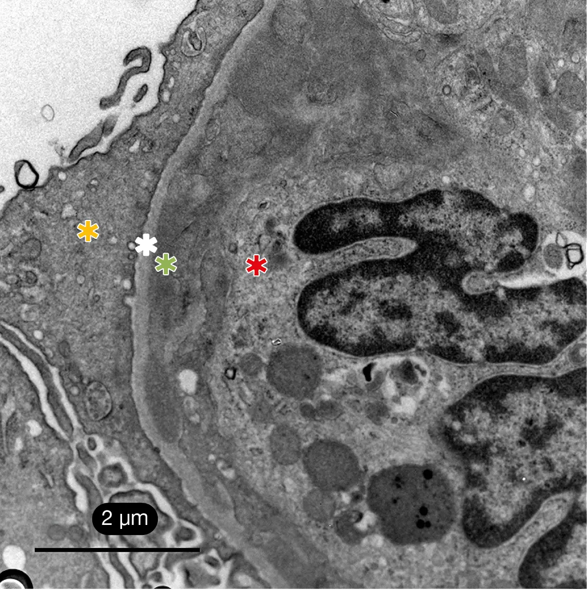 Microscopía electrónica de transmisión MET con depósitos electrodensos no estructurados subendoteliales en asa capilar