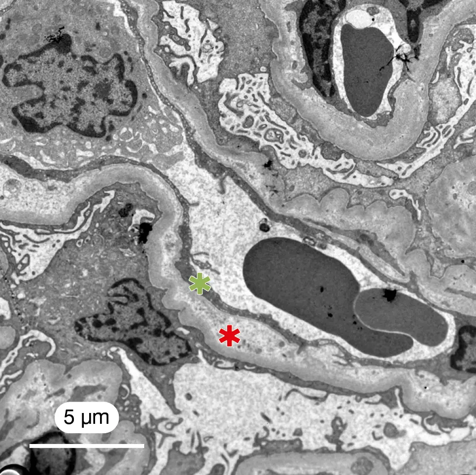 MET. Tanto la MAT como la GT comparten lesiones glomerulares ultraestructurales como las visibles en la imagen, consistentes en expansión del espacio subendotelial con aspecto electrolúcido granular (*) e hinchazón endotelial con pérdida de fenestraciones (*). 8000x.