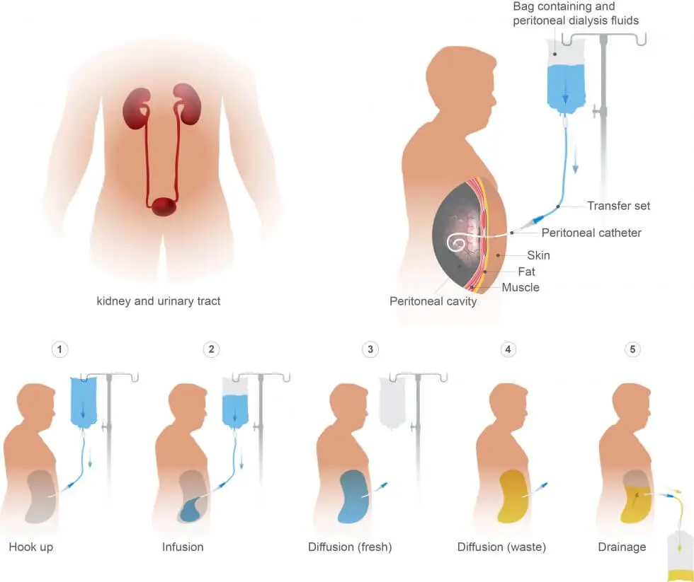 Imagen ilustrativa dialisis peritoneal