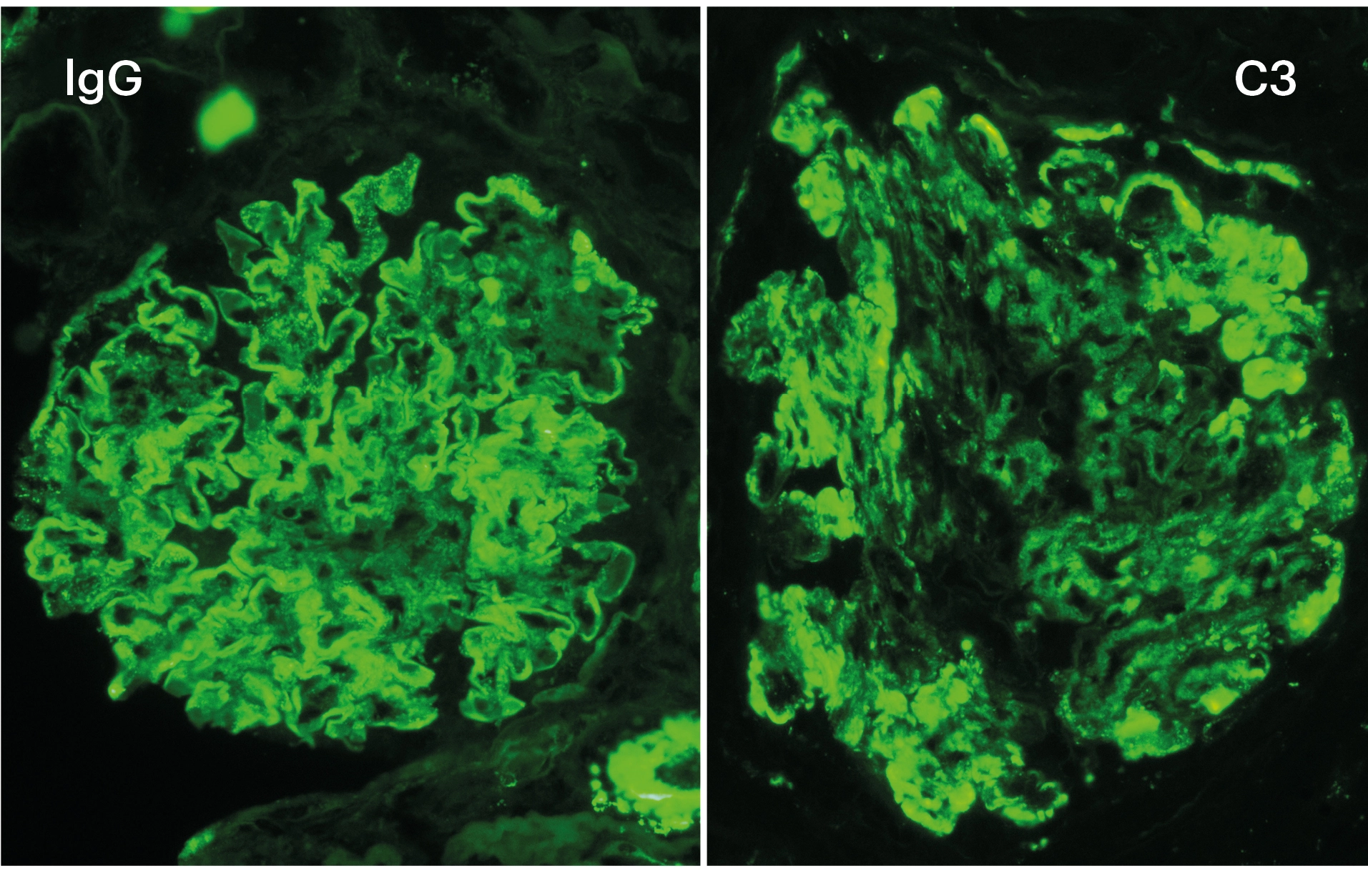 IFD con positividad granular para IgG y C3 en paredes capilares y mesangio en glomerulopatía inmunotactoide