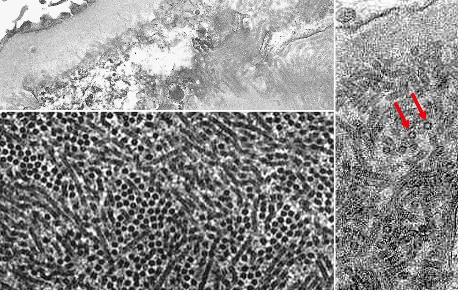 MET con depósito de microtúbulos con oquedad central de 30-50 nm en paredes capilares y mesangio en glomerulopatía inmunotactoide
