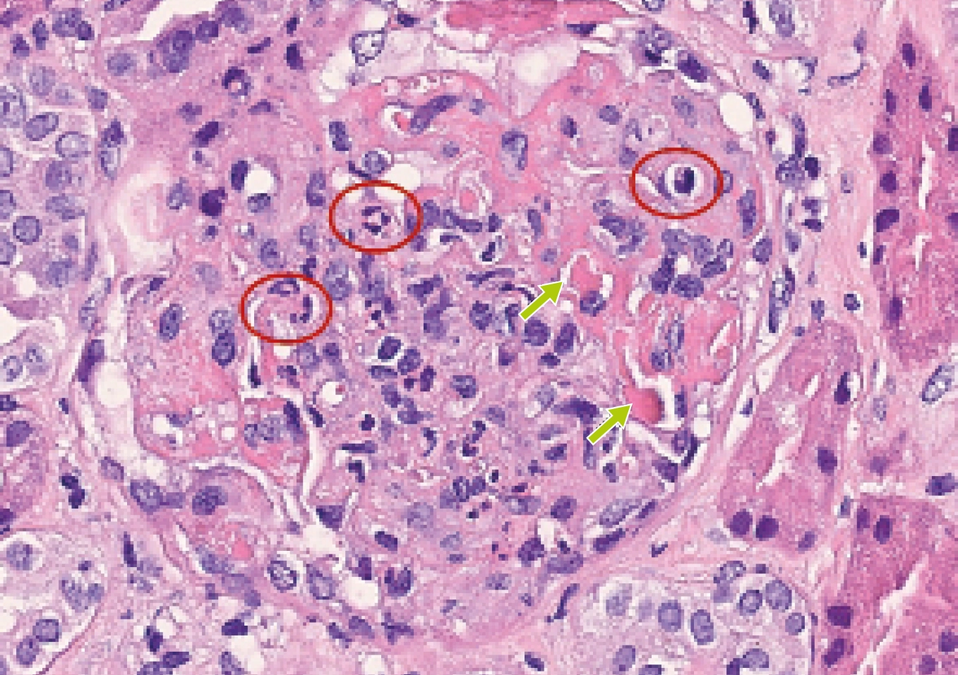 H&E con glomérulo hipercelular con proliferación endocapilar y trombos hialinos en vasculitis crioglobulinémica