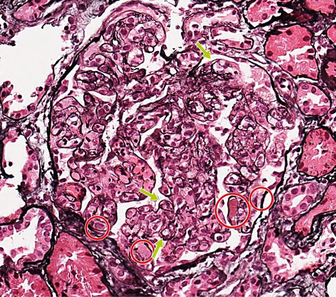 Plata metenamina con patrón membranoproliferativo, dobles contornos y trombos hialinos argéntica negativos en vasculitis crioglobulinémica