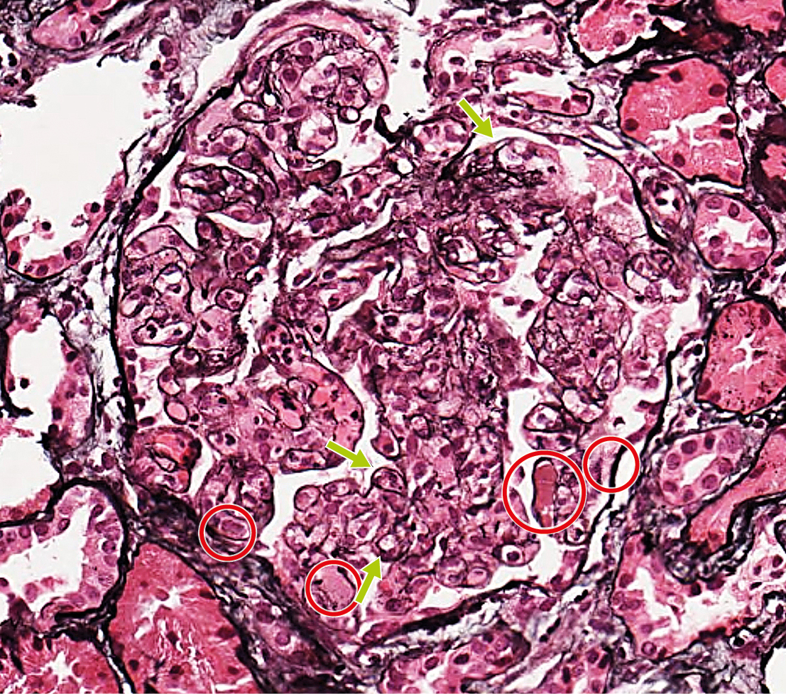 Plata metenamina con patrón membranoproliferativo, dobles contornos y trombos hialinos argéntica negativos en vasculitis crioglobulinémica